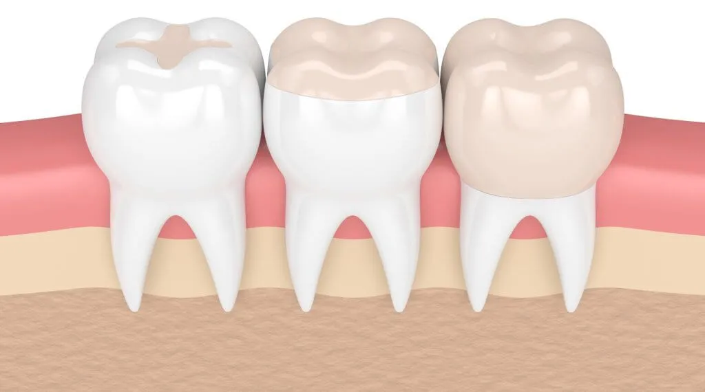 Representación de tres muelas que muestra un empaste, una incrustación y una corona