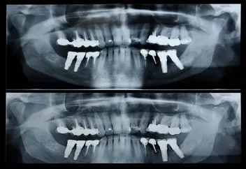 Une radiographie dentaire panoramique montrant une dentition complète